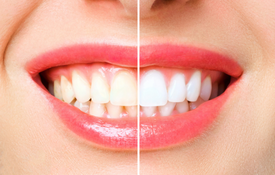 Aplicativos para Deixar Seus Dentes Brancos em Fotos
